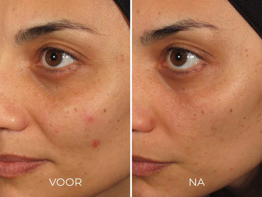 ILUMA - Intense Facial Illuminator