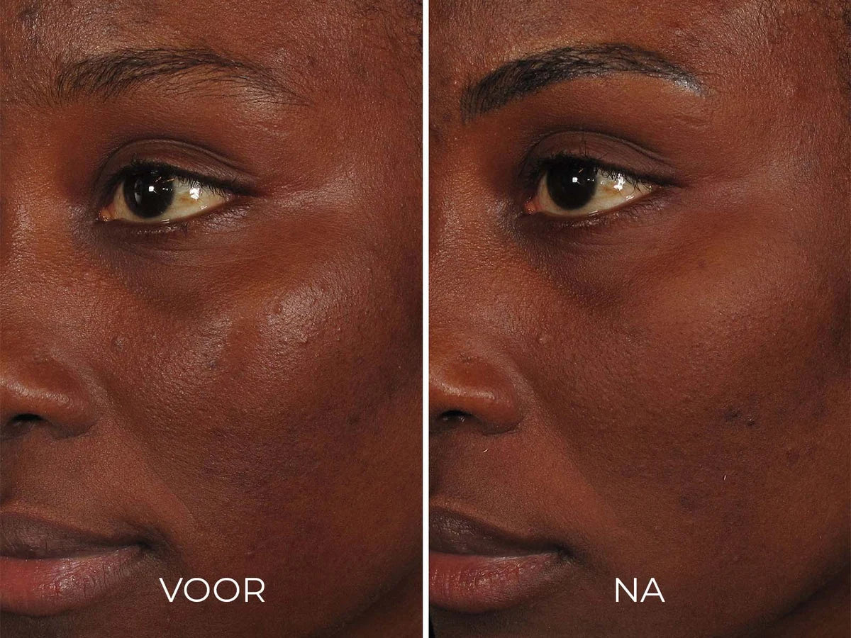 ILUMA - Intense Facial Illuminator